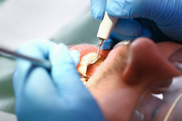 Best Emergency Root Canal Treatment in Candor, NC